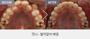 덧니