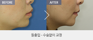 돌출입