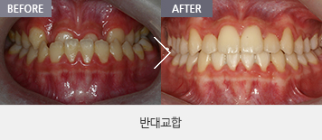 반대교합
